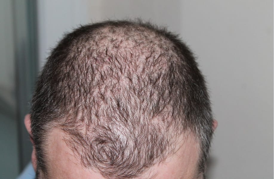 hair loss